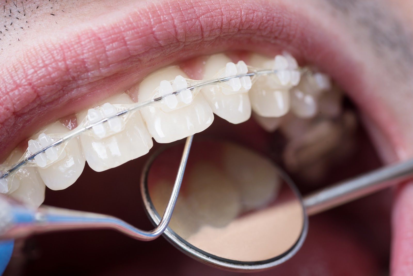 Qual Il Costo Di Un Apparecchio Denti Le Varie Tipologie Centri 