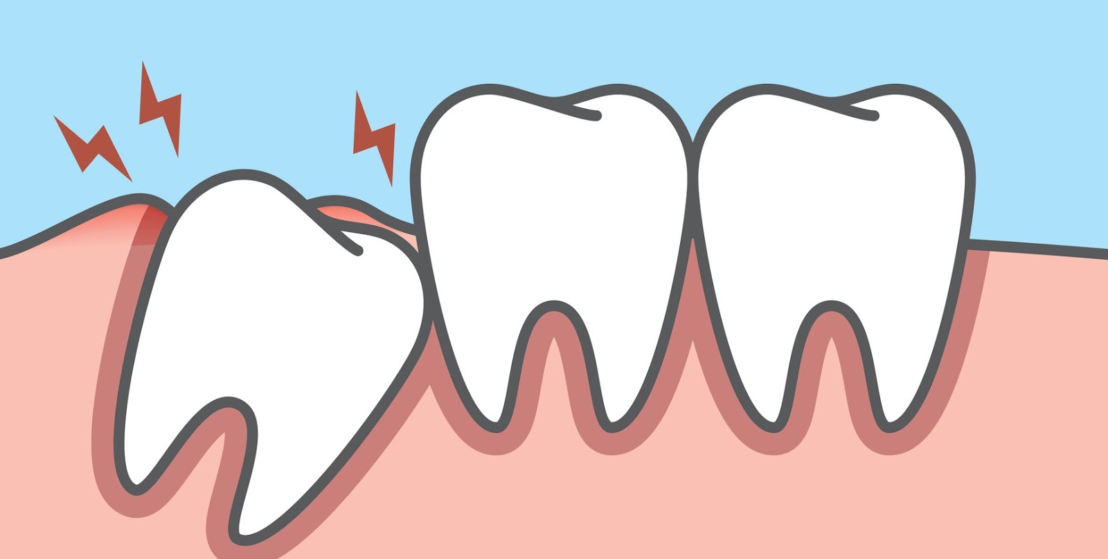 Dente Giudizio Eruzione Edited