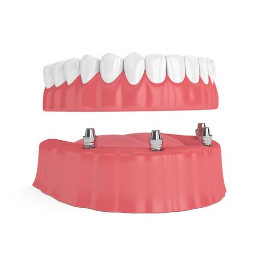 3d Render Of Removable Full Implant Denture Isolated Over White Background