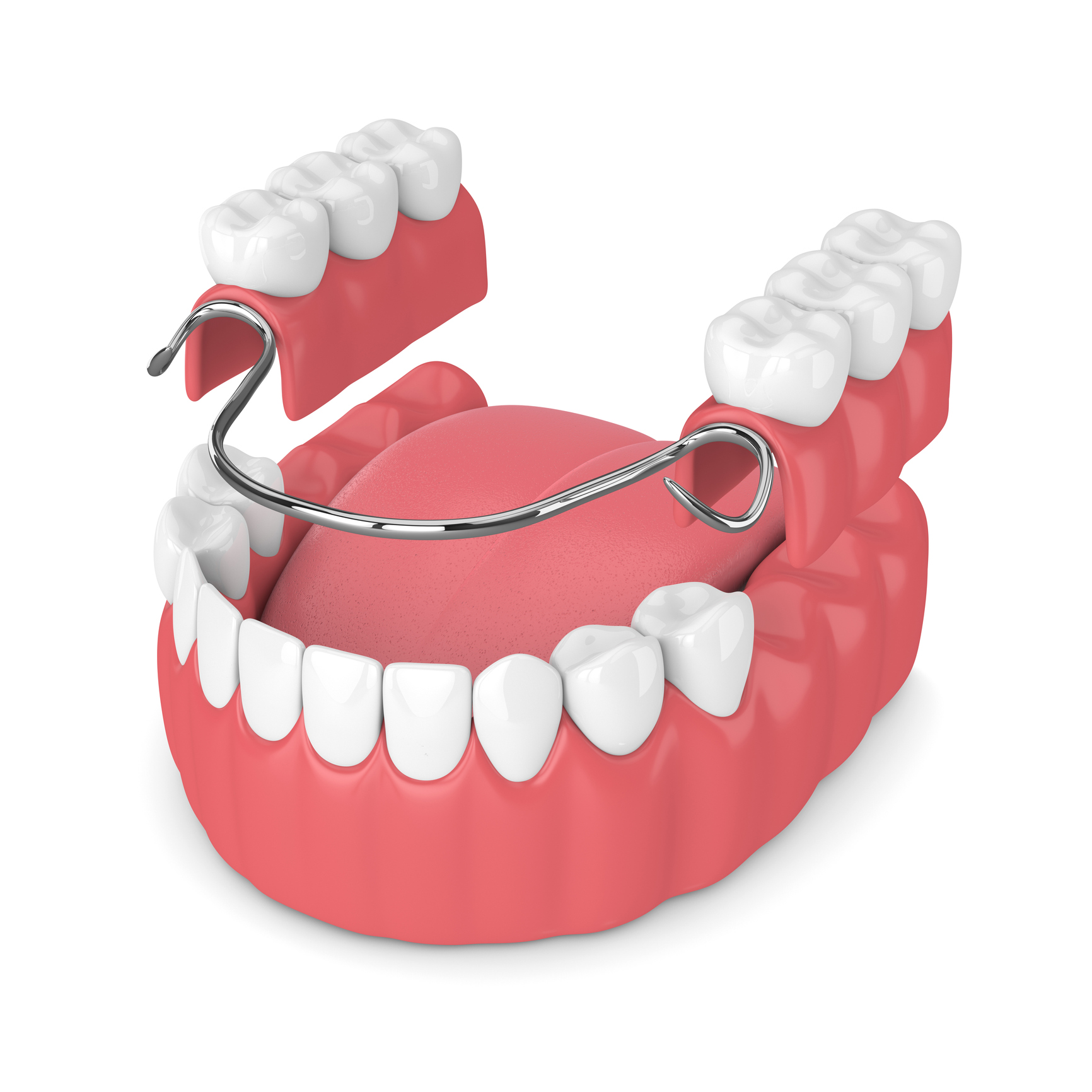 3d Render Of Removable Partial Denture