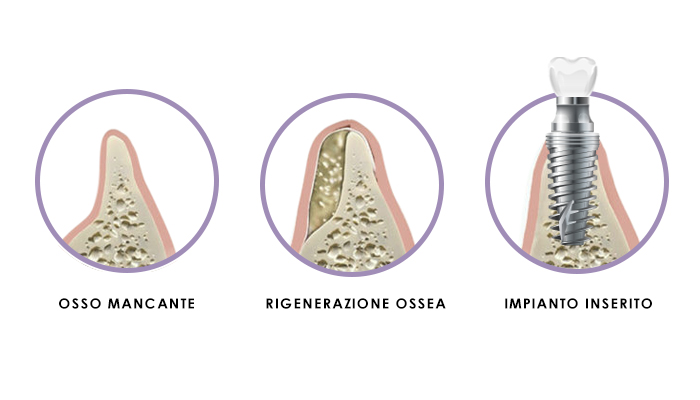 Rigenerazione Ossea Impianto