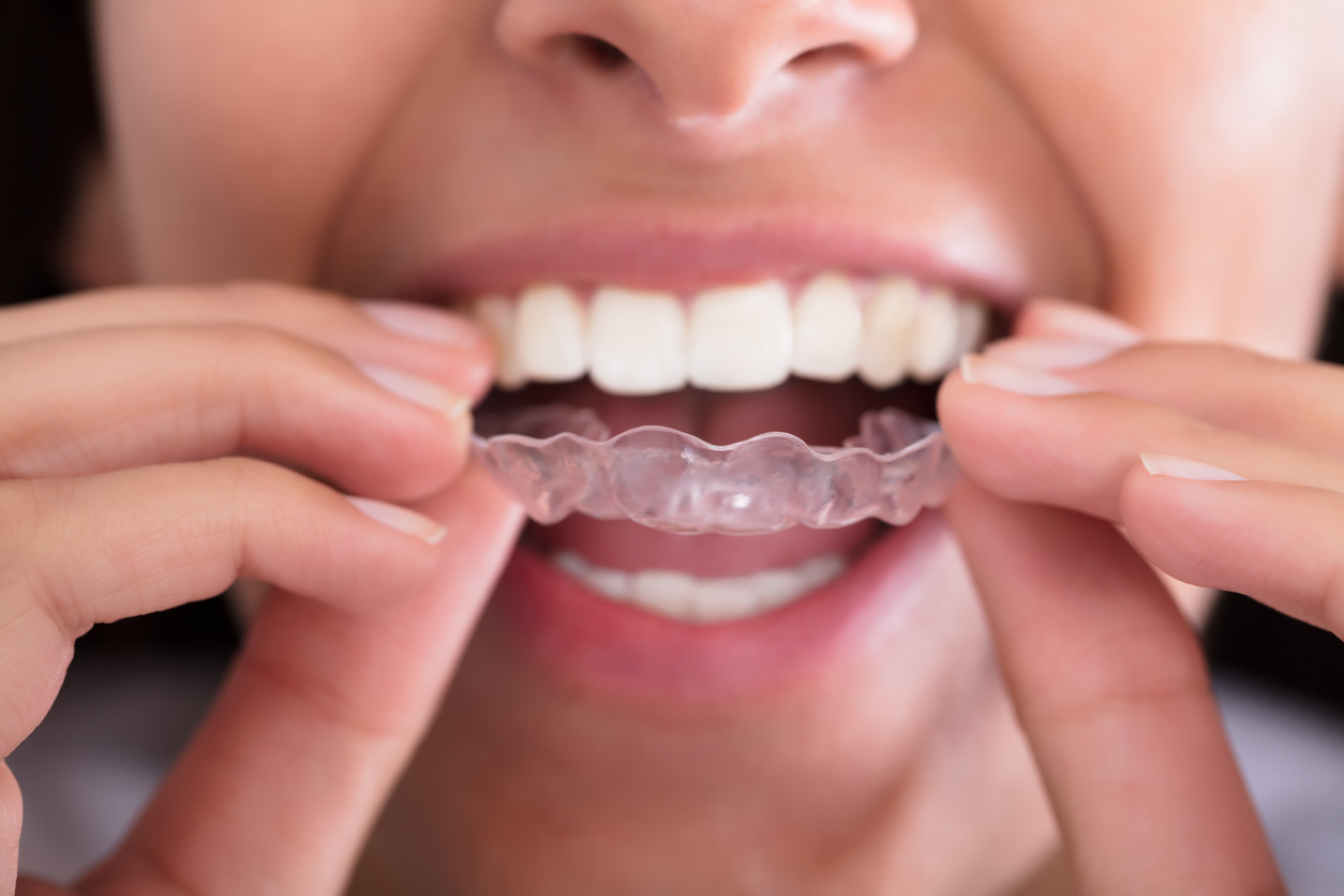 Woman's Hand Putting Transparent Aligner