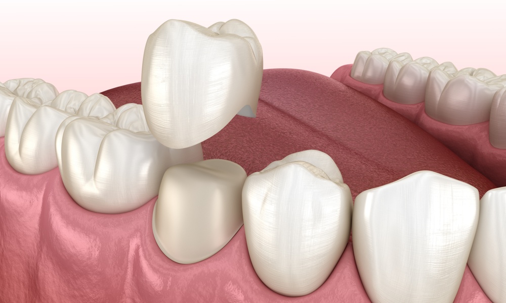 Quanto Dura Una Capsula Dentale