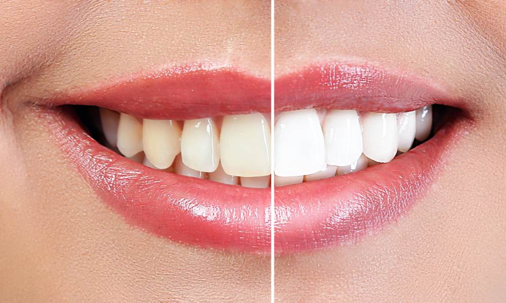 Differenza Tra Pulizia E Sbiancamento Dei Denti
