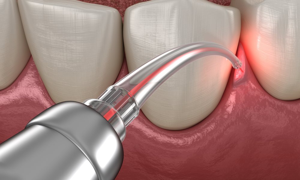Parodontite: Cure Laser Senza Interventi Chirurgici