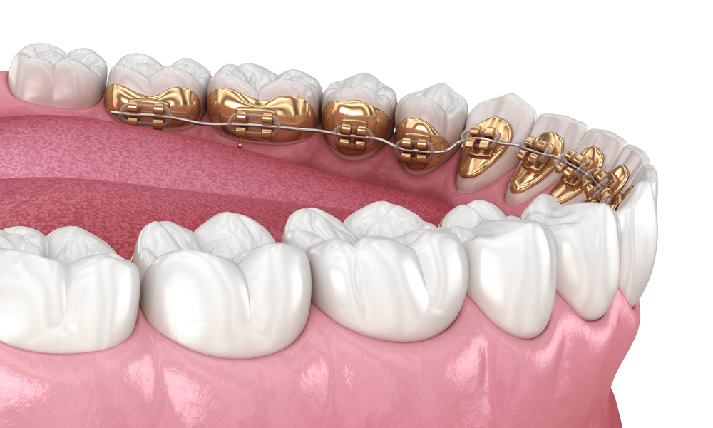 Cos'è L'apparecchio Per I Denti Interno