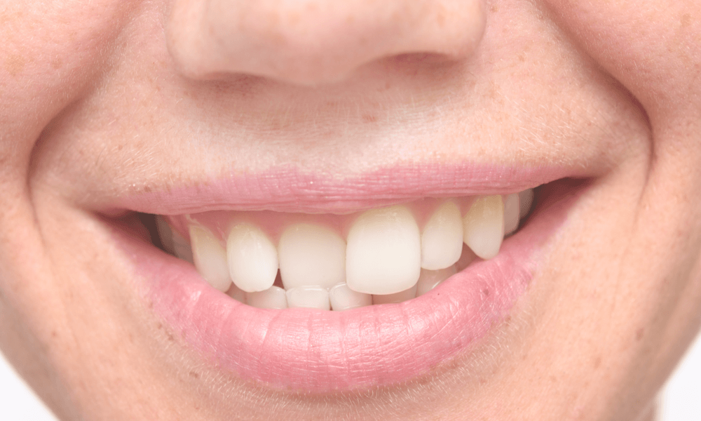 Denti Storti Conseguenze E Rimedi