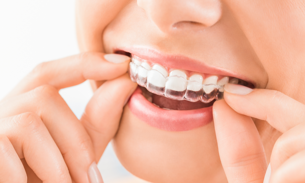 Apparecchio Dentale Trasparente Fisso E Mobile