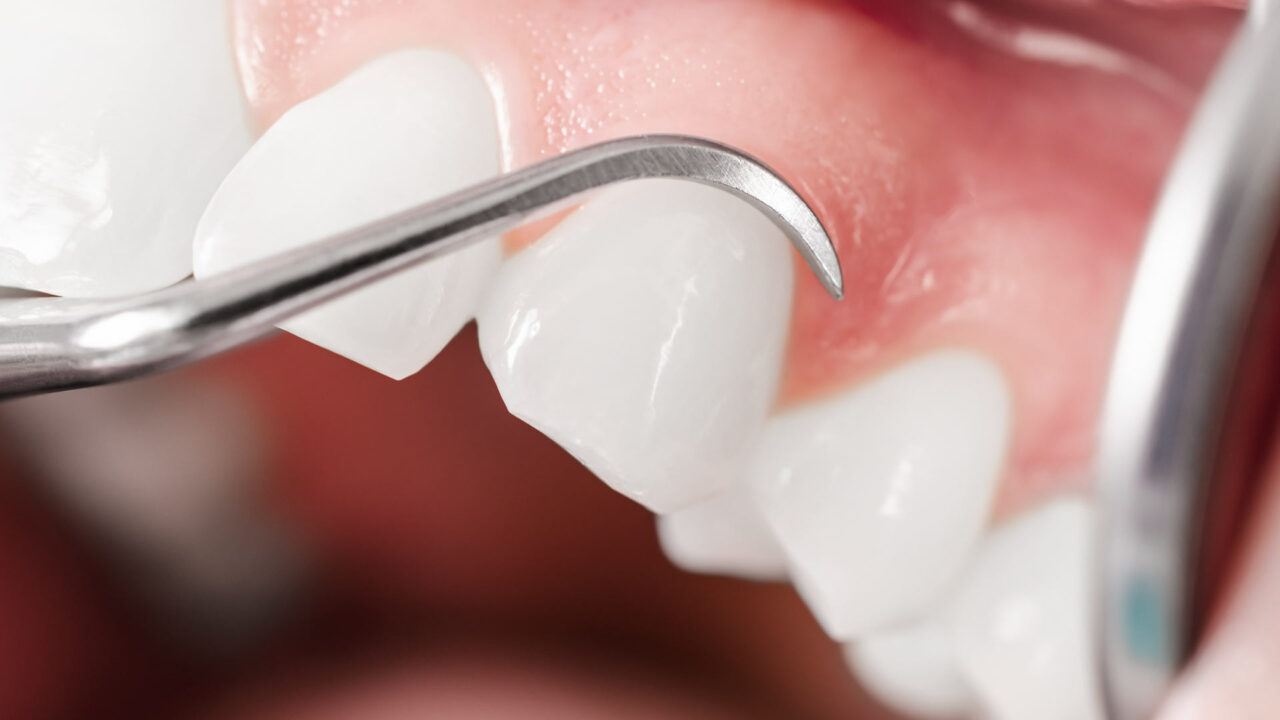 Cos'è il curettage chirurgico e quando viene fatto Centri Dentistici