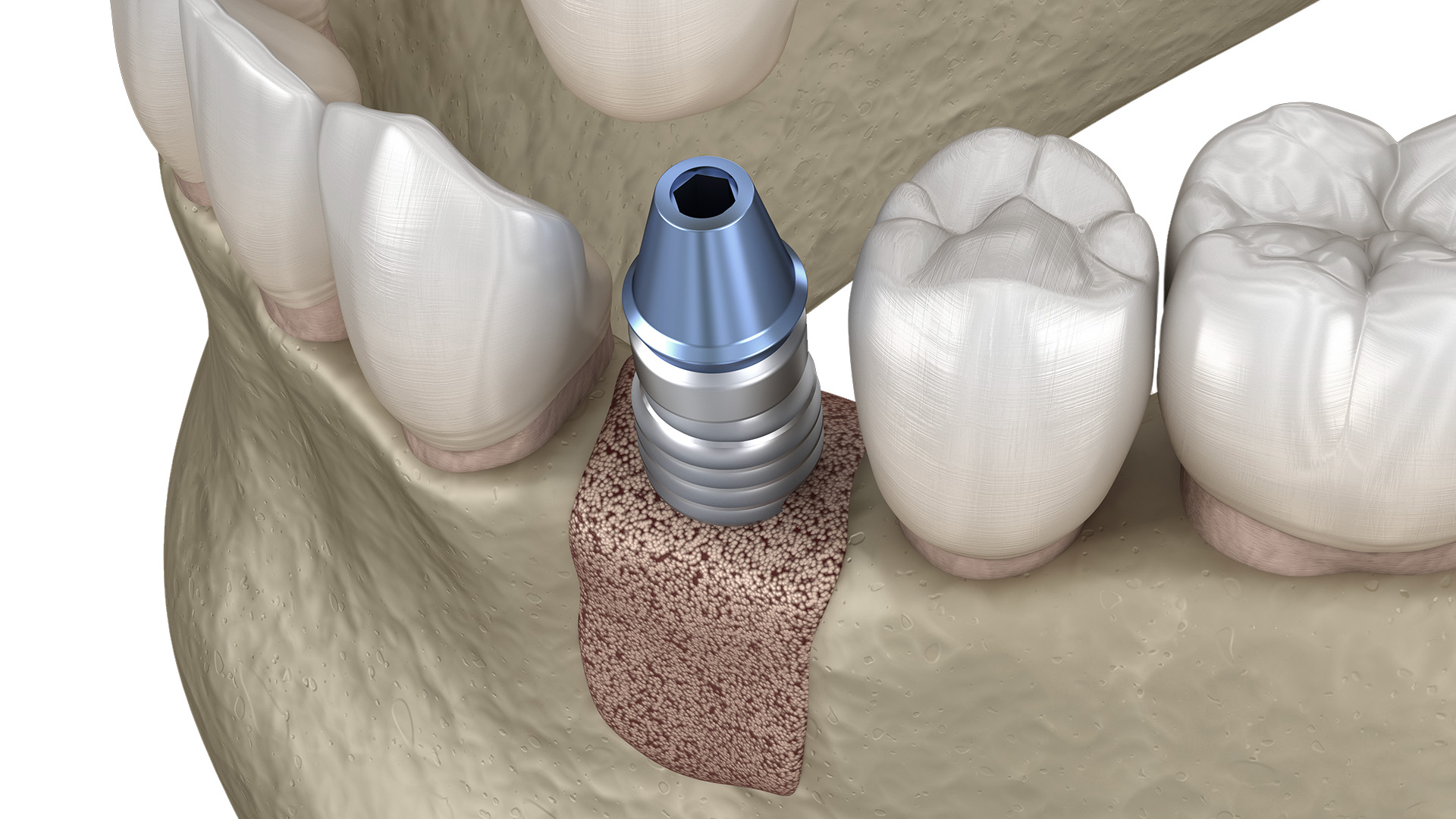 Siringa Dentale Impianto Inox Tedesco 5 Mm - Strumento Inst-Plus, Nuova